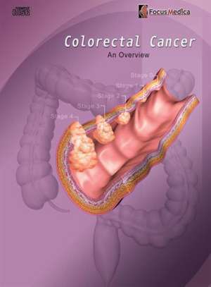 Colorectal Cancer de FOCUS MEDICA PTE LTD