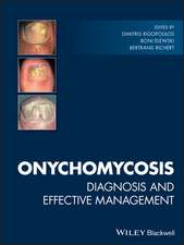 Onychomycosis – Diagnosis and Effective Management