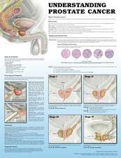 Understanding Prostate Cancer 2e Paper