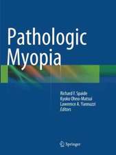 Pathologic Myopia
