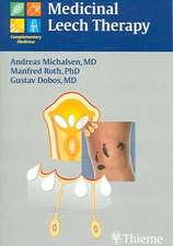 Medicinal Leech Therapy