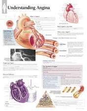 Understanding Angina Chart: Laminated Wall Chart