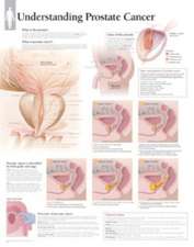 Understanding Prostate Cancer Paper Poster