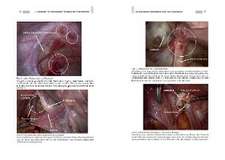 Endometriose - Die verkannte Frauenkrankheit