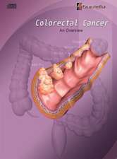 Colorectal Cancer